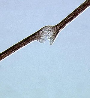 Tricho-hepato-enteric syndrome (1).jpg