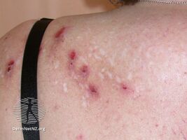 Compulsive skin picking