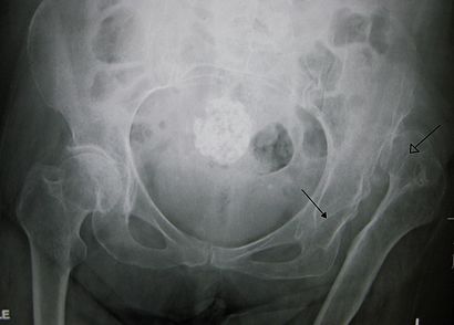 Congenitaldislocation10.JPG