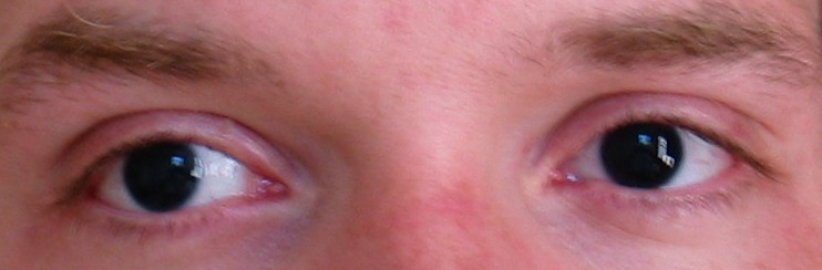 BlackEyesAniridia.jpg