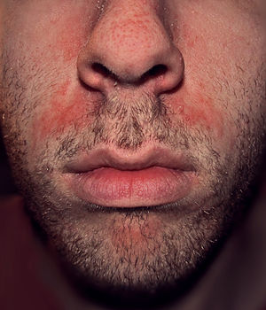 Seborrhoeic dermatitis highres.jpg