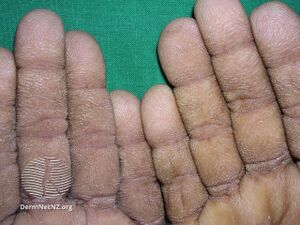 Tripe palms (DermNet NZ systemic-tripe-palms).jpg