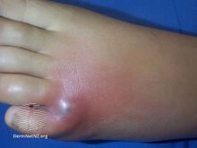 Spider bite-day 2