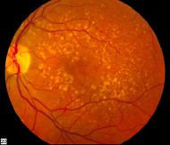 Intermediate age related macular degeneration.jpg