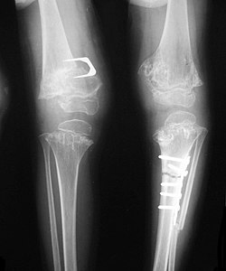 Pseudoachondroplasia. Leg radiographs depicting dysplastic distal femoral and proximal tibial epiphyses, and distal femoral metaphyseal broadening, cupping, irregularities (white arrows) and radiolucent areas especially medially. Note the metaphyseal line of ossification of the proximal tibias (blackarrows) and relative sparing of the tibial shafts. The changes around the knee are known as "rachitic-like changes". Lesions are bilateral and symmetrical.