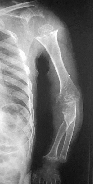 Pseudoachondroplasia. 01.jpg