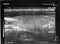 Fig. 2 Ultrasonic: Cross section of the right lobe