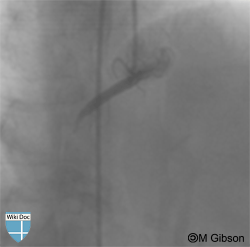 TIMI flow grade 0 in RCA: Outlined in blue in the second image is the flow of the dye which completely stops at the level of the stenosis; outlined with a yellow dashed line is the pathway that the dye would have filled in case the stenosis was absent.