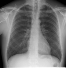 Non-Hodgkin lymphoma Lymphadenopathy.jpg