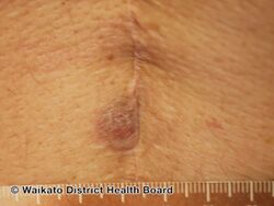 Erythema elevatum diutinum
