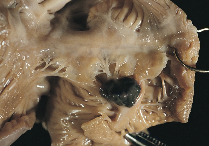 Blood cyst tricuspid valve 001.jpg