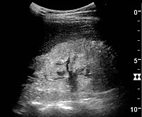 Nephrotic syndrome. Hyperechoic kidney without demarcation of cortex and medulla.[44]