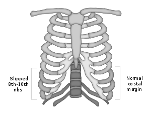 Slipping Rib Syndrome Example.svg