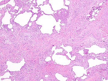 Appearance of usual interstitial pneumonia (UIP) in a surgical lung biopsy at low magnification. The tissue is stained with hematoxylin (purple dye) and eosin (pink dye) to make it visible. The pink areas in this picture represent lung fibrosis (collagen stains pink). Note the "patchwork" (quilt-like) pattern of the fibrosis.