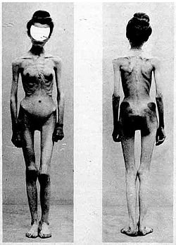 431px-Anorexia case 1900.jpg