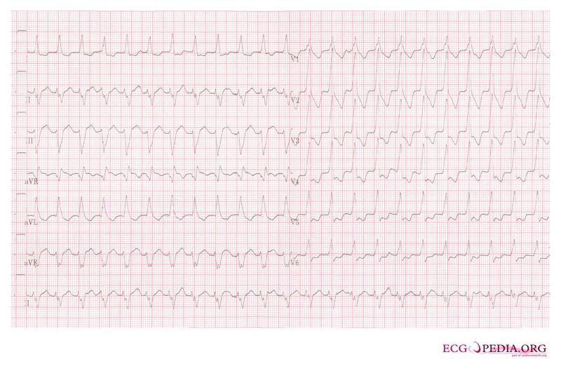 Ventricular Tachycardia 1.jpg