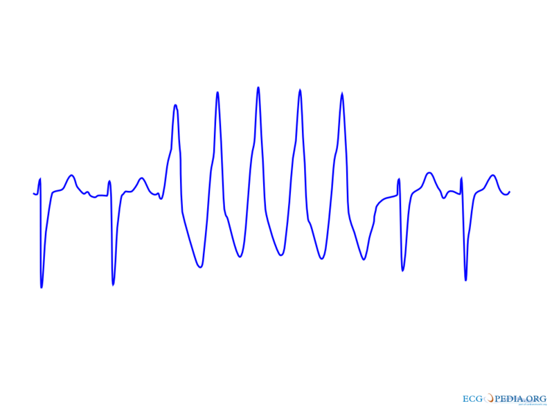Ventricular Tachycardia 2.png
