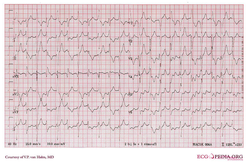 Ventricular Tachycardia 3.jpg