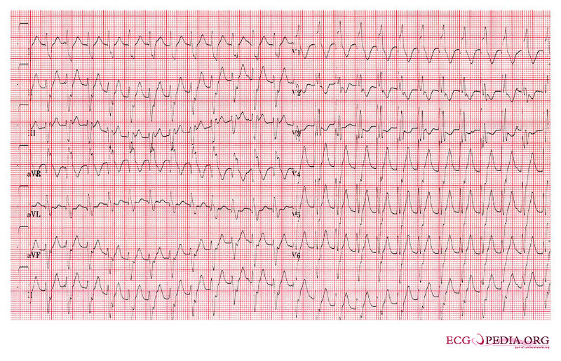 Ventricular Tachycardia 4.jpg
