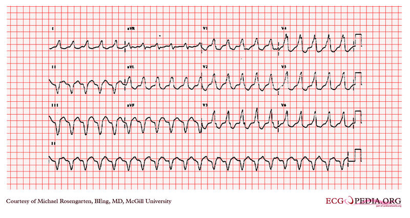 Ventricular tachycardia.jpg