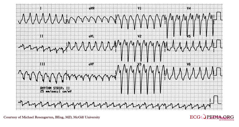 Ventricular tachycardia 1.jpg