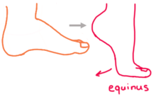 Equinus Illustration.png