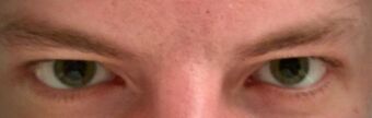 Mydriasis due to LSD usage.jpg