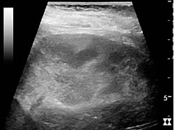Acute pyelonephritis with increased cortical echogenicity and blurred delineation of the upper pole.[16]