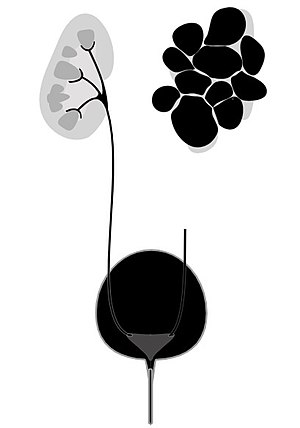 Multicystic dysplastic kidney.jpg