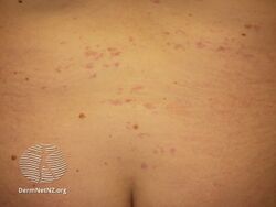 Benign hereditary telangiectasia