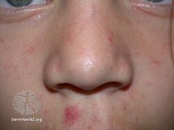 Benign hereditary telangiectasia