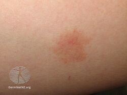 Benign hereditary telangiectasia