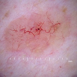 Dermoscopy nodular basal cell carcinoma.jpg